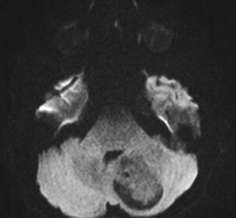 Unenhanced axial CT scan demonstrates well-defined cystic and solid mass with multiple
