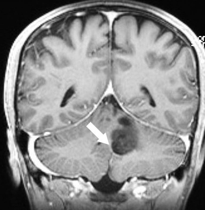 Mass exhibits iso- to hypointensity (relative to normal gray matter) on axial T1-weighted MRI