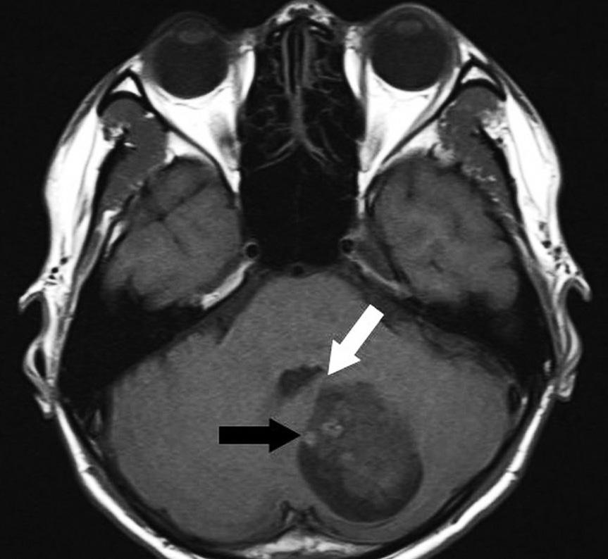 There were multiple, small, high-signal intensity lesions (black arrow) suggesting