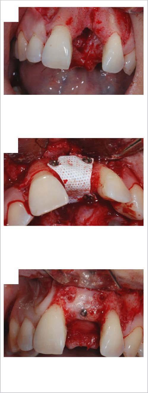 CASE STUDIES 1 1 SEVERE BONE DEFECT OF THE ANTERIOR CENTRAL INCISOR REVEALING VERTICAL BONE LOSS TOOTH 21 IS AFFECTED BY