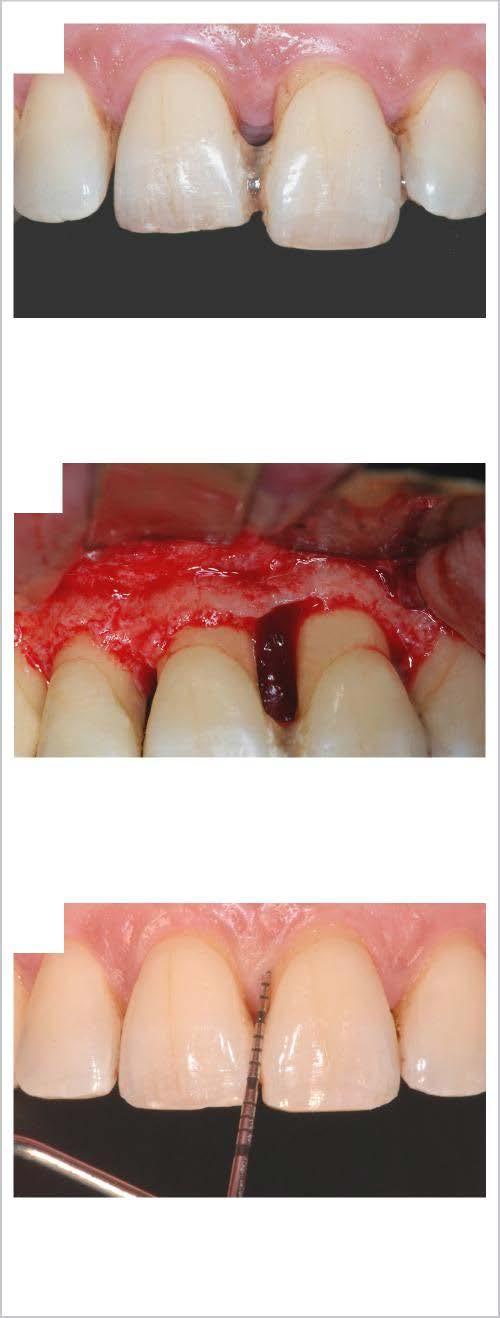 AND XENOGRAFT PARTICLES PERIOPERATIVE VIEW SHOWING A 4mm INTRABONY DEFECT 3 3 AFTER 6 MONTHS, THE PTFE MEMBRANE IS