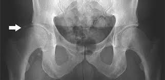 Can Hip arthroscopy in the Presence of Arthritis Delay the Need for Hip Arthroplasty? Journal of Hip Preservation Surgery. 2017, Vol. 4, No.