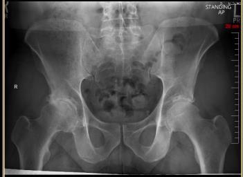 Case 1 49yo male 15yrs of right hip
