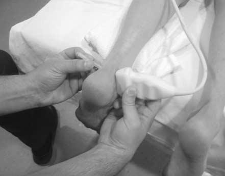 Flexor Hallucis Longus Tendon Sheath Injection guidance for therapeutic delivery of corticosteroids and local anesthesia.