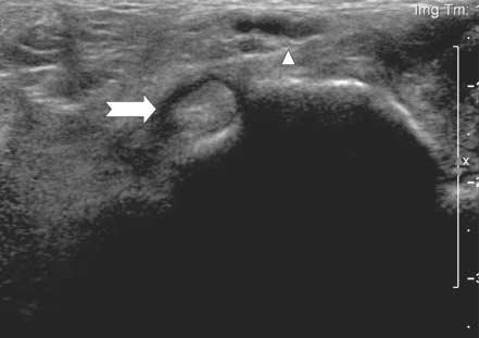 The same needle was then advanced within the tendon sheath under direct sonographic guidance.
