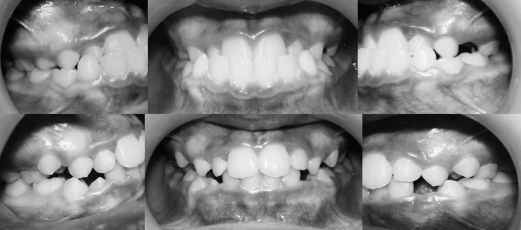 960 ABDELNABY, NASSAR Figure 5. Pre and posttreatment intraoral photographs of patient utilized chin cup with 300 grams of force per side. groups in comparison with the untreated group.