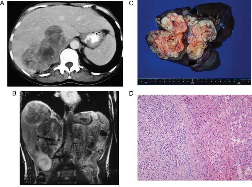 Jpn J Clin Oncol 2007;37(2) 111 Figure 1. Abdominal CT scan and MR imaging in patient No. 7 showing a huge mass invading the liver and the inferior vena cava (A, B).