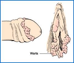 Diseases: Venereal Warts Application of vinegar; visual inspection Figure 62-3 Venereal warts Slide 19 Diseases: Venereal Warts Medical and Surgical Management Self application of Podofilox