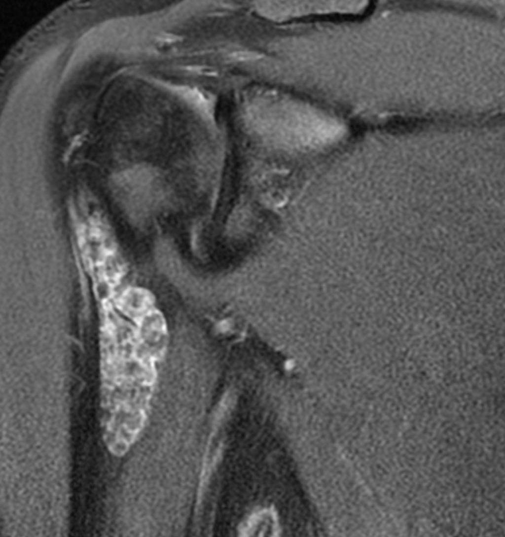 Fig. 5: RM coronal T2 in a patient with primary synovial chondromatosis shows proximal distention of long biceps tendon sheath with multiple loose bodies inside with