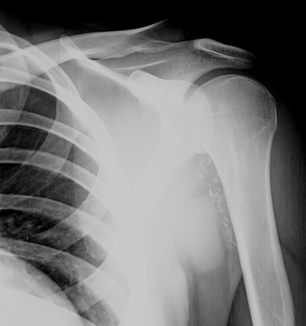 Fig. 6: Radiographs reveal multiple intra-articular calcifications or well-defined