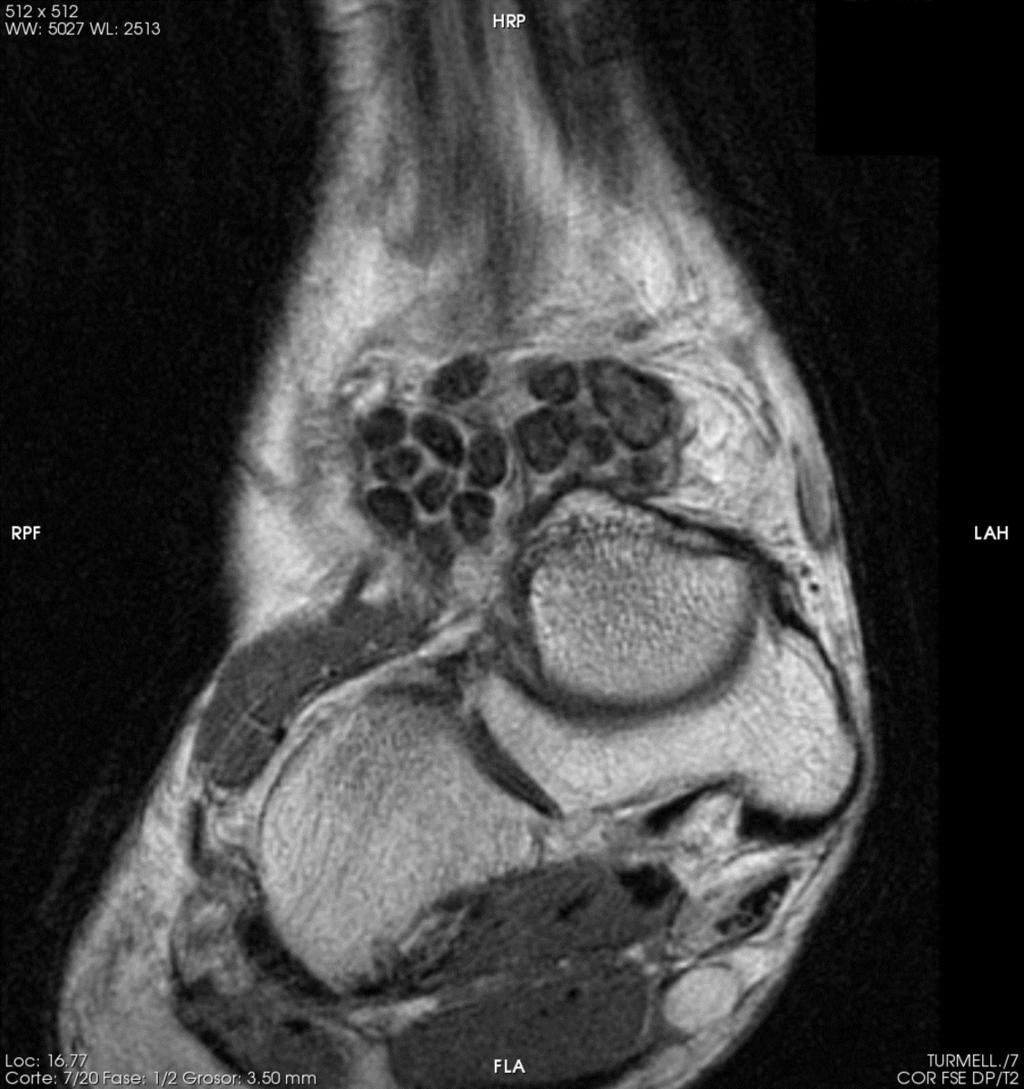 Fig. 9: Ankle sagittal T2 RM. Synovial chondromatosis.