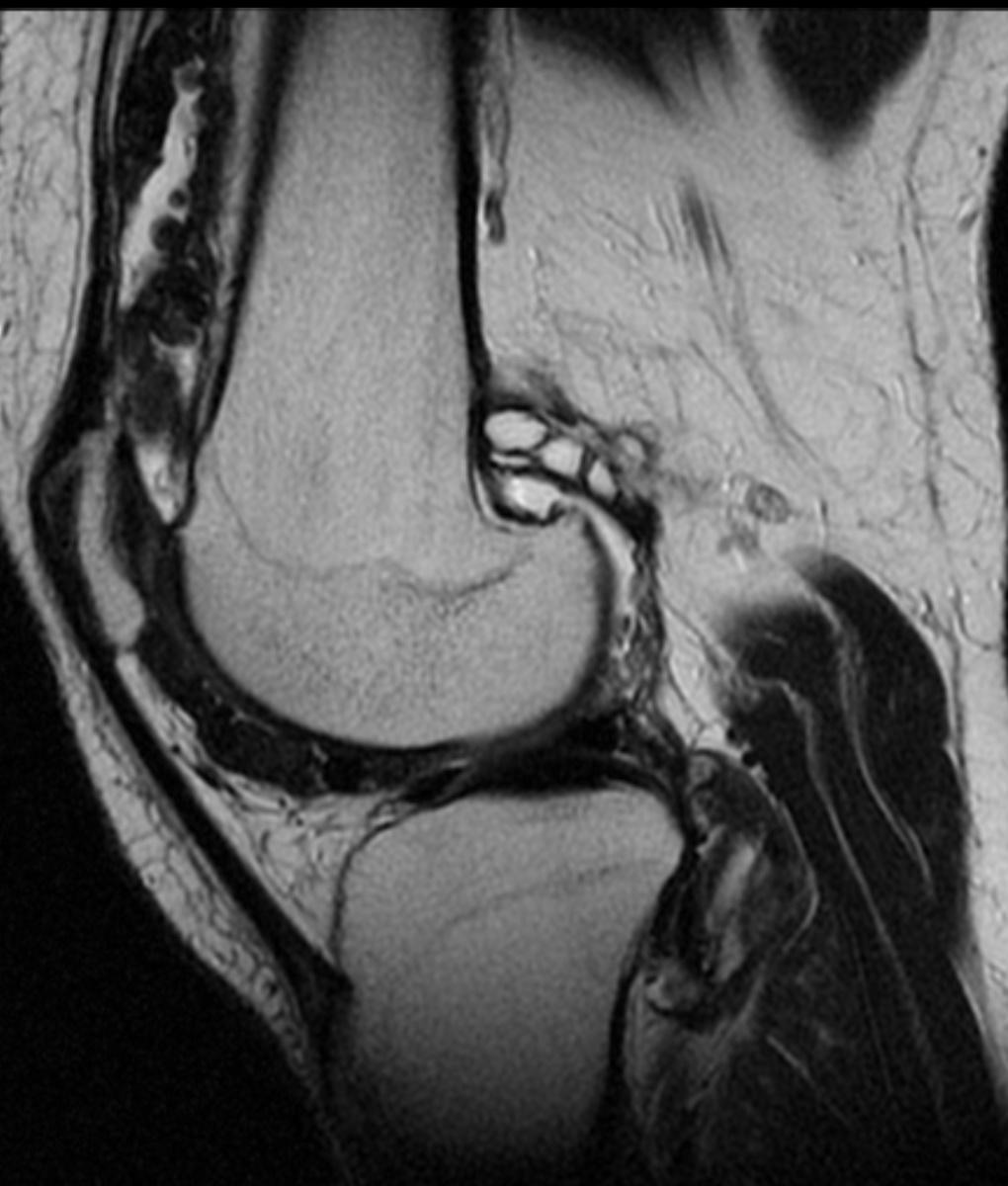 Fig. 10: sagittal Knee T2 RM.
