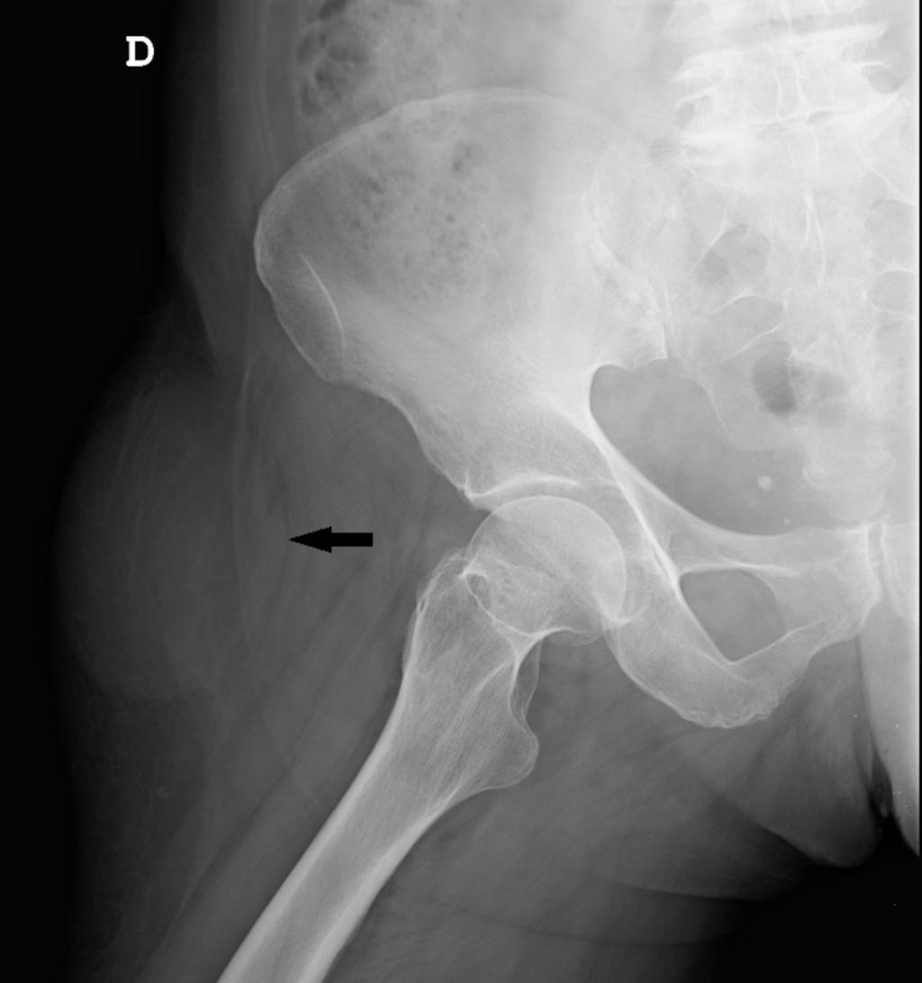Fig. 2: Hip radiograph showing a soft tissue