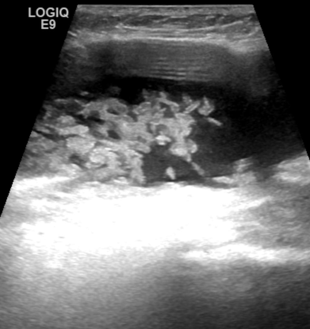 Fig. 3: Shoulder ultrasound showing numerous intrabursal hyperechoic nodules