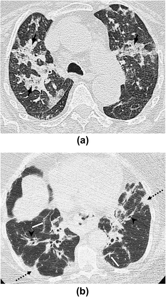 826 S. Dixon, R. Benamore / Clinical Radiology 65 (2010) 823e831 Figure 3 HRCT images demonstrating proven COP. Consolidation (short arrows) occurs in 90%.