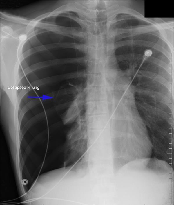 Pneumothorax Common with chest injuries.