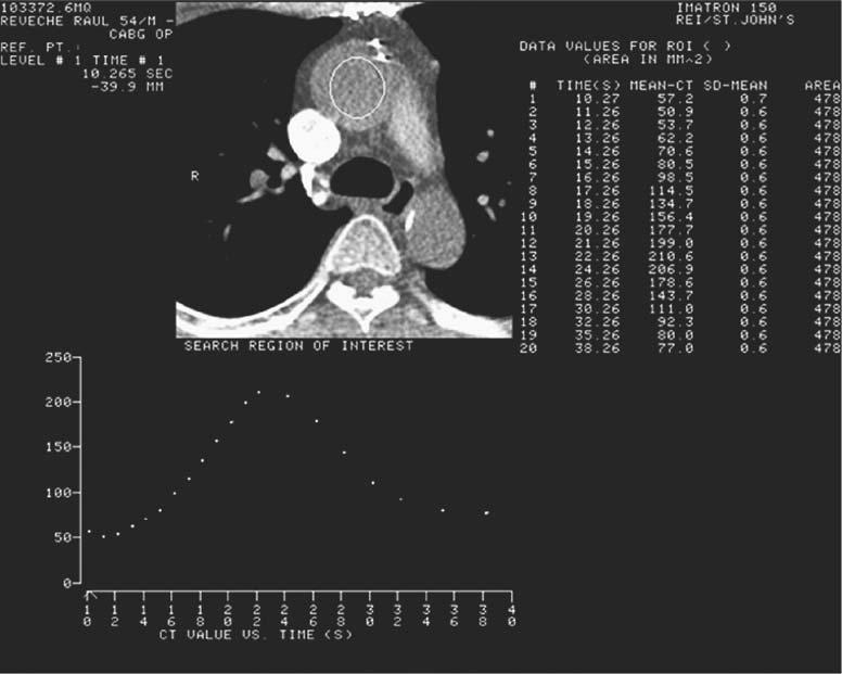 44 Cardiac CT Imaging: Diagnosis of Cardiovascular Disease Figure 4.2. Flow study on an electron beam scan, demonstrating a rise and fall of the contrast density during the timing study.