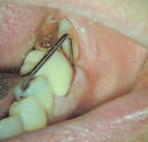 Isolated deep probing 11mm here Visual examination Start with the face, checking for enlarged jaw muscles, which may indicate a habit of overstressing the teeth during mastication.
