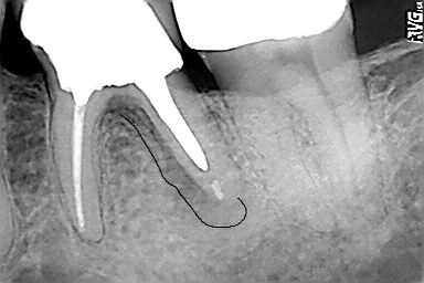 Next, check the teeth for tight cuspal fossae relationships that may cause excessive occlusal stresses. Note any steep cusps or developmental grooves, because these may predispose teeth to cracks.