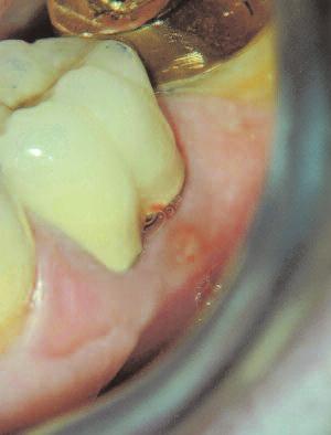 Also check for cracked restorations or unusual gaps between restorations and tooth structure. Enhanced magnification and illumination can be helpful in visual identification of a crack.