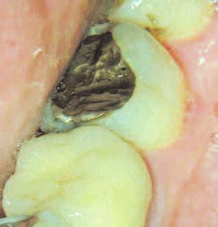 Significant cracks in heavily restored teeth Crack visualised under clinical microscope extending to MB root access A thickened periodontal ligament space or a diffuse longitudinal radiolucency,