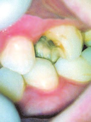 Total cuspal fracture most often in posterior teeth The cracks discussed in this article exclude cracks caused by impact trauma, which are more common in the anterior teeth, tend to result in more