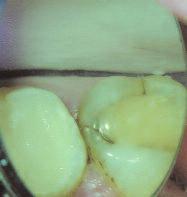 Their treatment also has the best prognosis, especially when the crack does not extend below the gingival attachment.