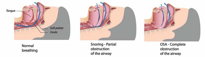 Obstructive Sleep Apnea: upper airway obstructions (complete or partial)