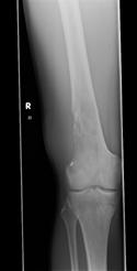 Ewing s sarcomas often have a significant soft tissue component (c). Figure 4: Chondrosarcoma of the proximal humerus with pathological fracture.