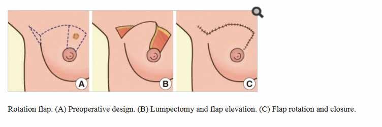 b) Rotation flap Incisions of the rotation flap include a semi-circular line of the upper inner quadrant (UIQ) of the NAC and a parallel semicircular arc at the margin line of the breast UIQ (Figure