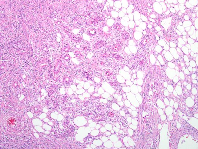 Perivascular epithelioid cell neoplasm (PEComa) Mesenchymal neoplasm composed of PECs Angiomyolipoma without fat Broad group that includes: Angiomyolipoma Clear