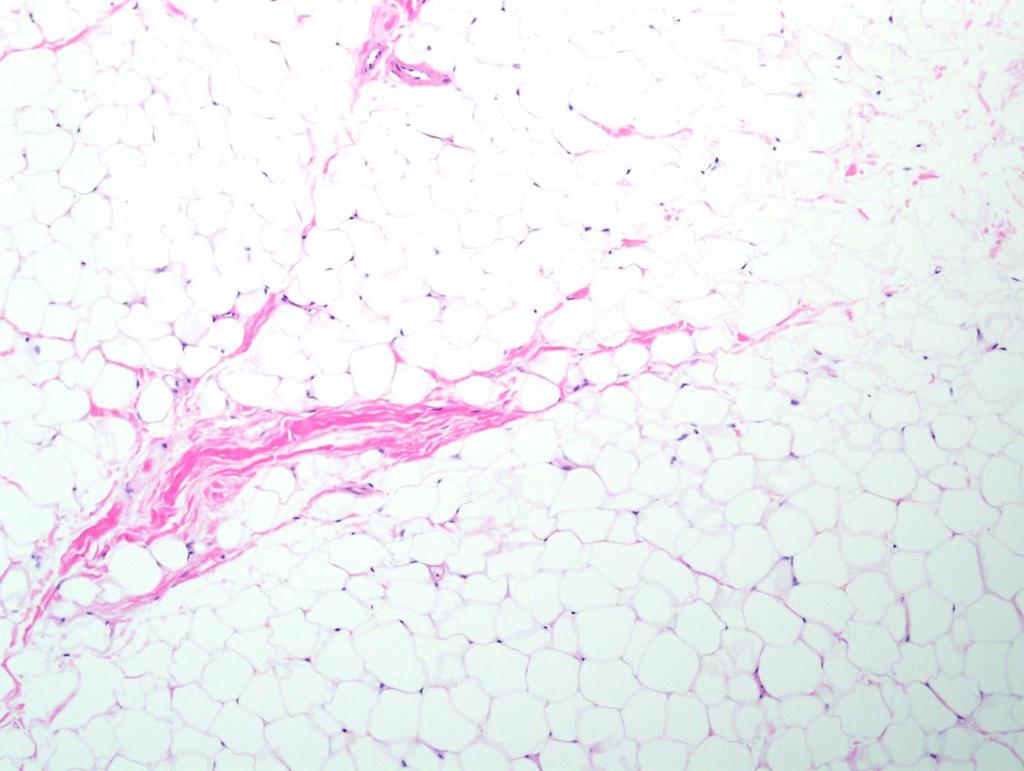 40 year old male with 5 cm subcutaneous thigh mass. 1. Location 2. Atypical hyperchromatic stromal cells? 3.