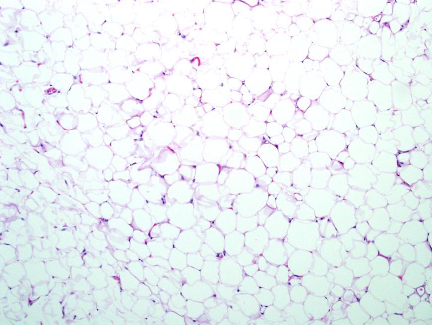 stromal cells 55-75% have