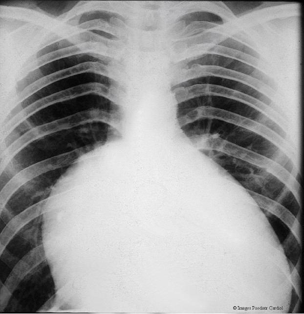 Ebstein's anomaly showing the classic appearance of cardiomegaly, small aortic knuckle, small pulmonary arteries giving the appearance of underfilled lungs, dilated inferior vena cava and huge right