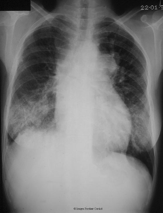 Classic appearance called coeur en sabot once said to suggest Fallot's tetralogy. In fact it is often seen with pulmonary atresia with ventricular septal defect.