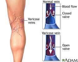 Varicose veins or arteries are veins that have become enlarged and tortuous.