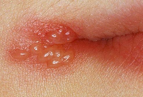 Cold sores > called fever blisters groups of small blisters on the lip and around the mouth The skin around the