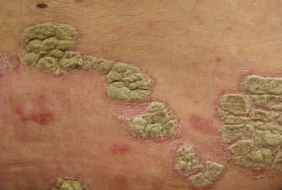 Psoriasis is inflammatory skin disease Characterized by a red, scaly rash, which can be itchy A typical lesion is a well-defined