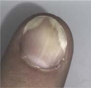 flexures Nails to become pitted, discolored and fragile Cause Unknown > more common in some families Associated factors: Predisposal