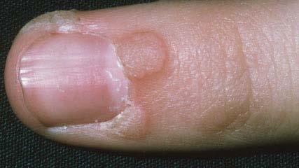 A round or oval growth on the skin with a rough surface.