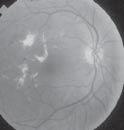 retinopathy (when new blood vessels grow or proliferate).