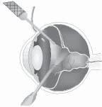 VITRECTOMY In some patients, there may be bleeding into the vitreous or the vitreous may pull on the retina reducing vision severely.