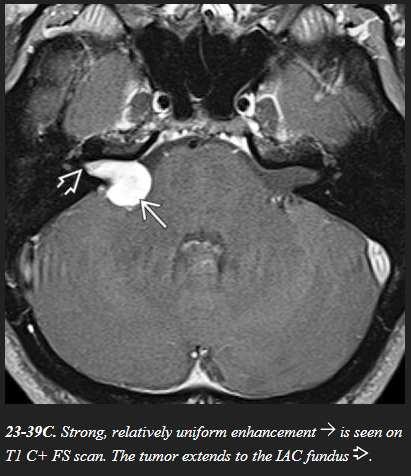 Virtually all VSs enhance strongly following contrast administration. A schwannoma-associated "dural tail" sign occurs but is rare compared to CPA meningiomas.