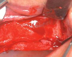 Sinuslift Soft tissue management for sinuslift Bone augmentation in the maxilla-palatal sliding flap Bone