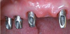 Strategy and procedures on Prosthetic implant planning abutment
