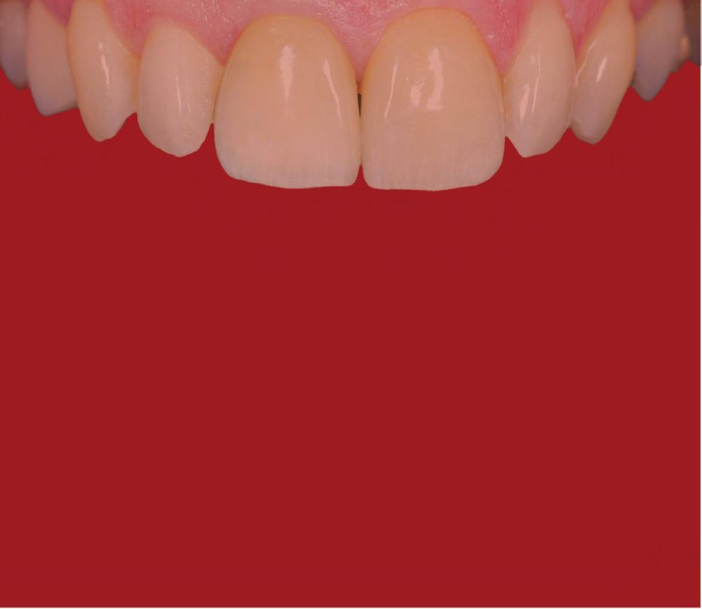 Module 4 Soft Tissue Complication Gingival recession around implants-how to repair Papilla development after papilla loss Prosthetic soft tissue solutions Soft tissue development for multiple