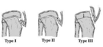Knee Tibial tubercle classification Ogden classification center Type 1 fracture of secondary ossification center (insertion of patellar tendon)