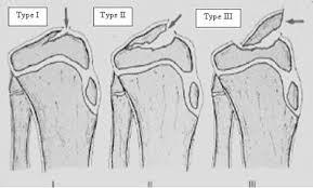 Knee Tibial eminence fractures Meyers and McKeever classification Type 1