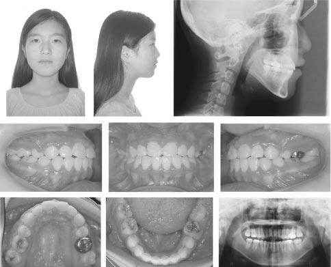 Pretreatment cephalograph, extraoral and intraoral photographs, and panoramic radiograph (case 1).