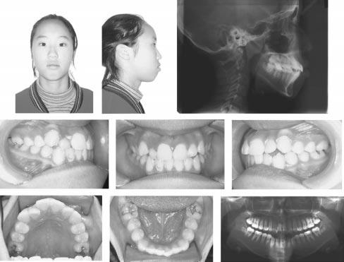 Pretreatment cephalograph, extraoral and intraoral photographs, and panoramic radiograph (case 2). FIGURE 5. Cephalometric superimposition (case 1). CASE 2.